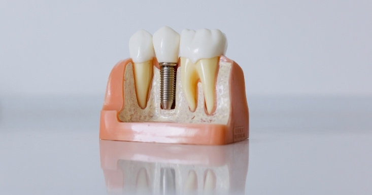 can dental implants work as speech therapy