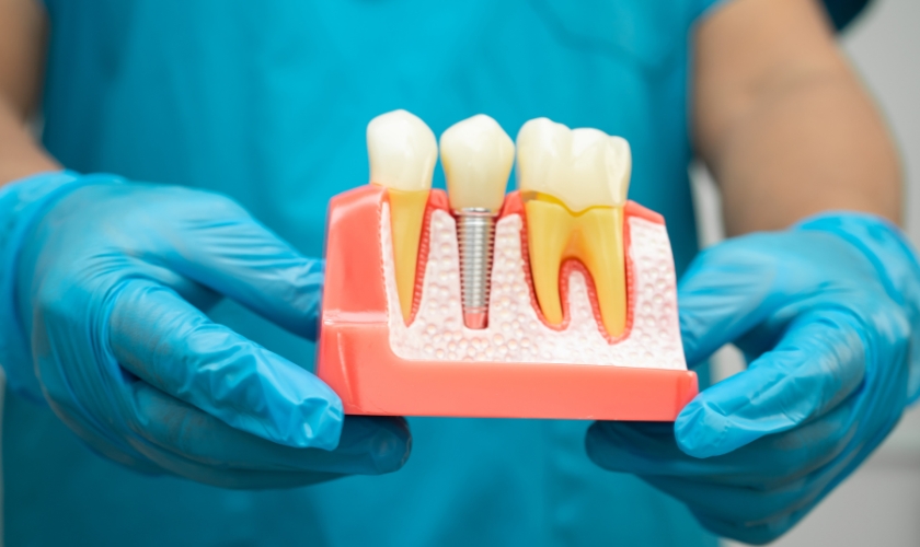 dental implants in Austin