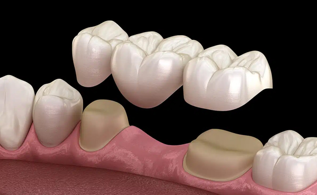 Illustration of a porcelain dental bridge replacing missing teeth in Austin, TX