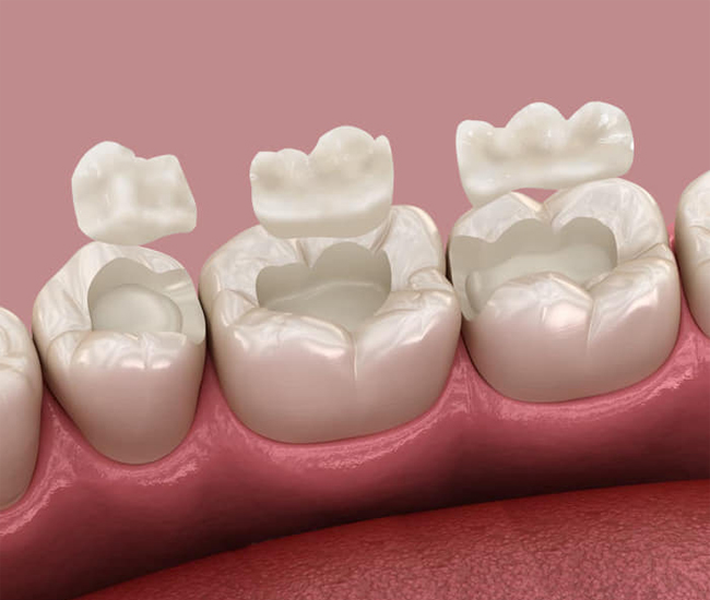 Dental onlays placed on molar teeth to restore damaged tooth structure in Austin, TX