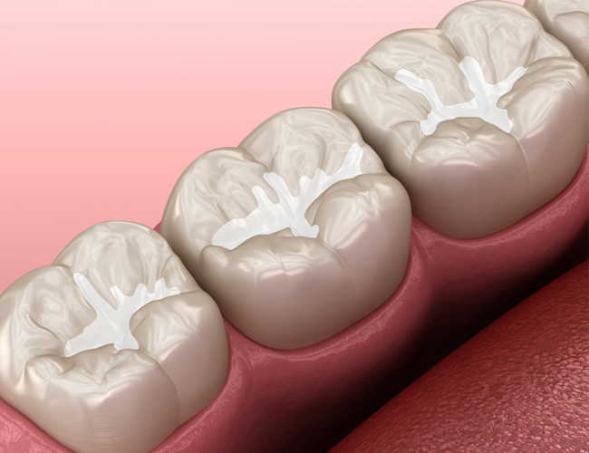 Dental sealants applied to molars to prevent cavities at Hapi Dental in Austin TX