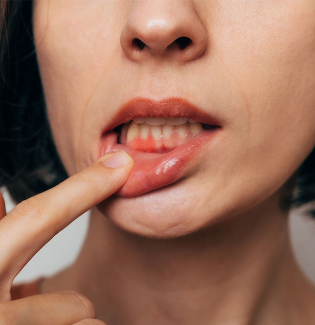 Patient showing inflamed gums as a sign of periodontal disease before gum treatment at Hapi Dental in Austin TX