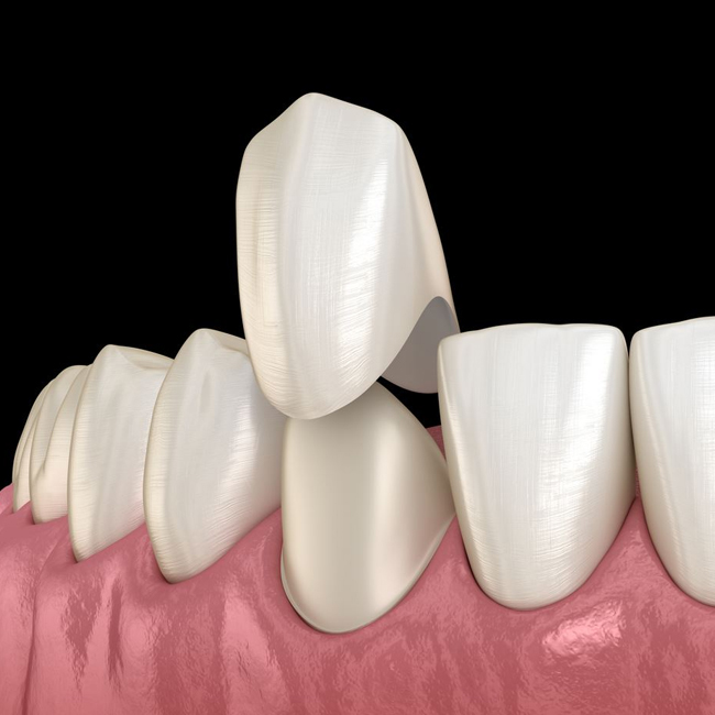 Porcelain dental crown being placed over a prepared tooth for restoration in Austin, TX