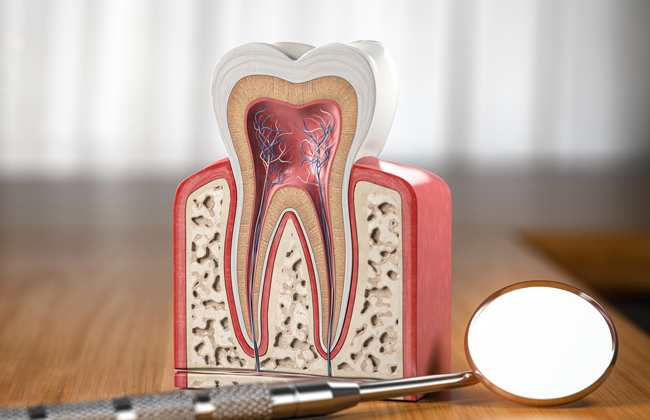 Cross-section diagram of a tooth showing root canal treatment for infected pulp in Austin, TX