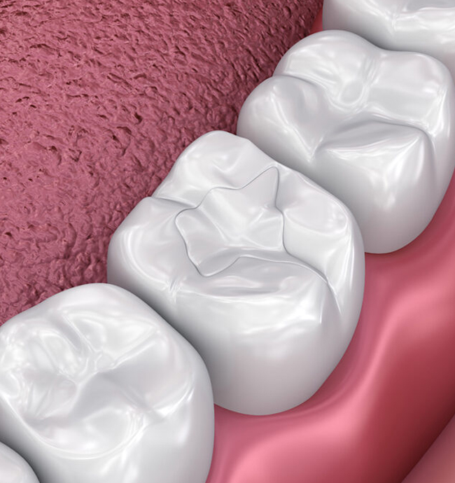 Composite fillings restore cavities while blending naturally with your tooth color