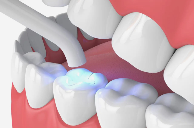 Dentist placing a tooth-colored composite filling to restore a cavity in Austin, TX