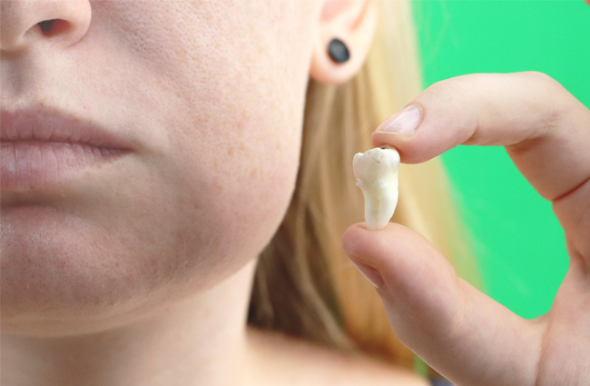 Patient holding a removed wisdom tooth after wisdom teeth extraction in Austin, TX